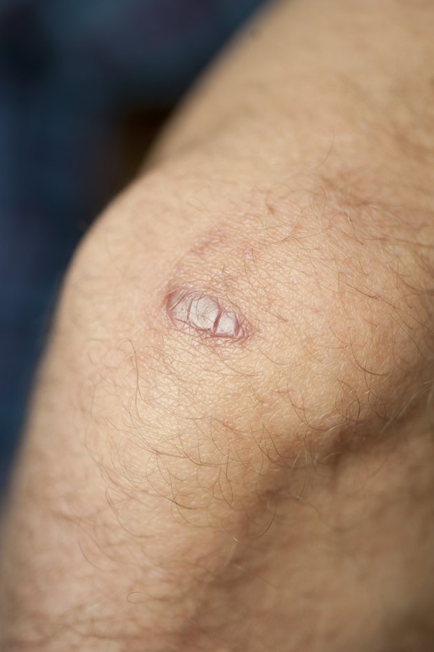 Keloid Scar