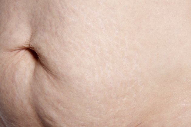 Woman showing her stretch marks