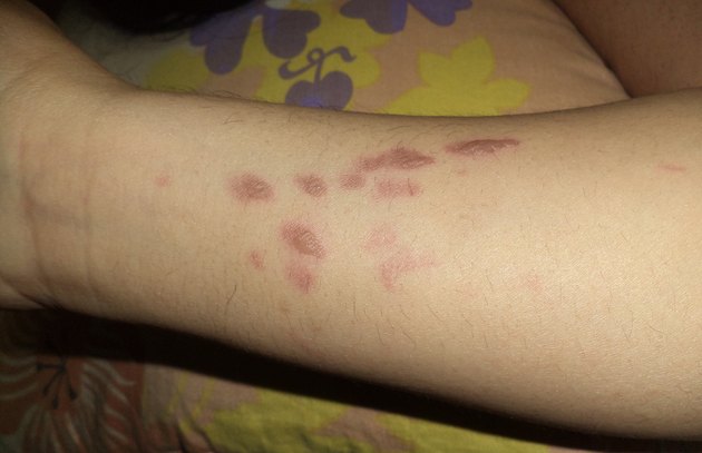 Burn marks