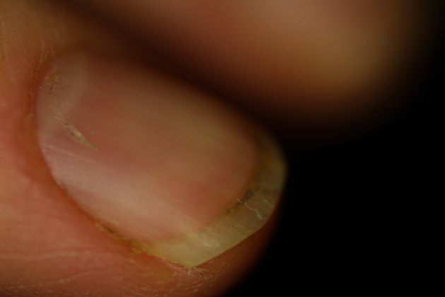 How to Get Rid of Mold on the Fingernails | Livestrong.com