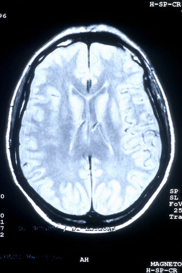 Brain scan