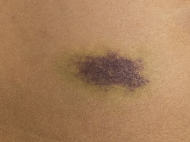 My Pinched Arm Is Now Blue | Livestrong.com