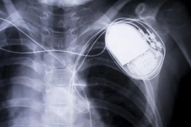 x-ray chestx-ray chest