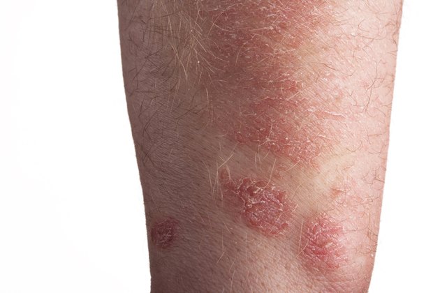Psoriasis on the arm