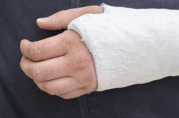 Man with his broken arm. Arm in cast.