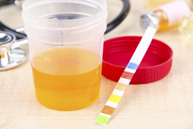 How To Interpret Dipstick Urinalysis Results Livestrong Com