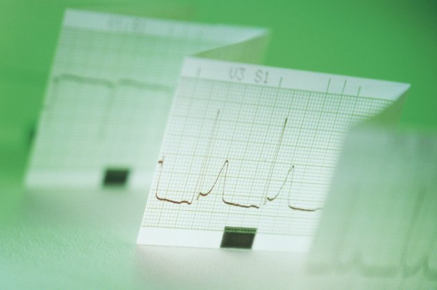 Printout of electrocardiogram