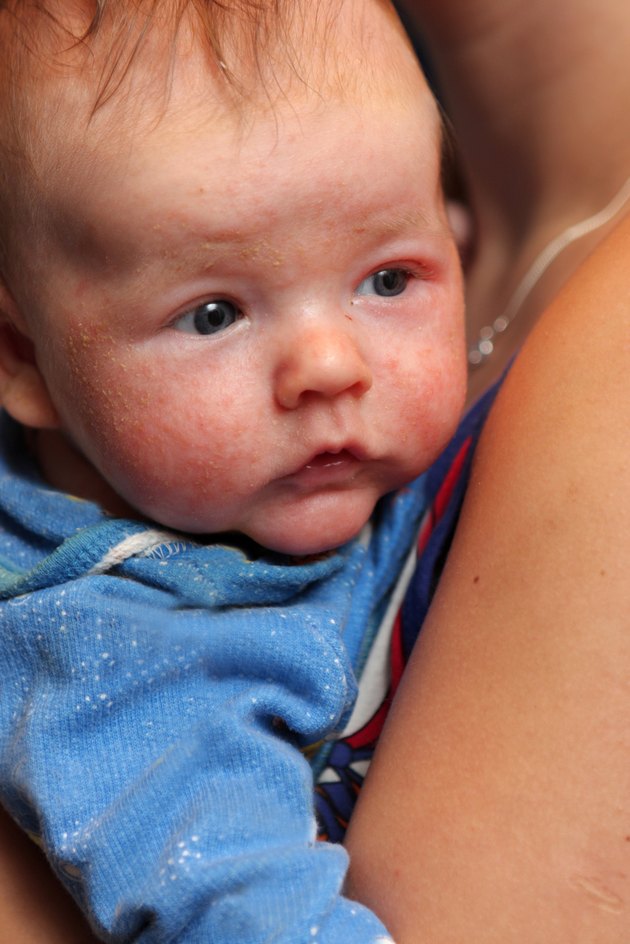 Infant with eczema on face