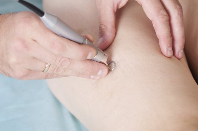 Spider veins medical laser, surgery
