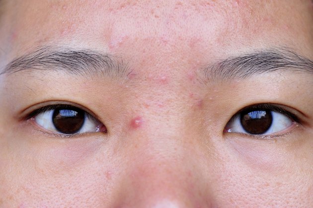 acne on face