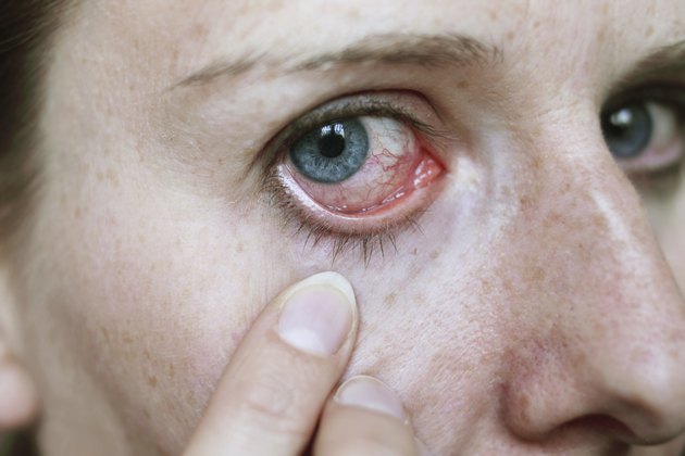 red eye after hayfever attack
