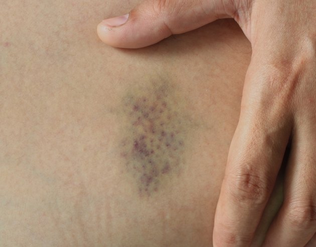 Closeup Bruise on wounded woman's leg skin