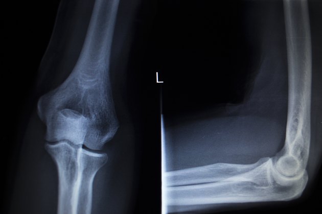 X-ray orthopedics Traumatology scan of elbow joint injury