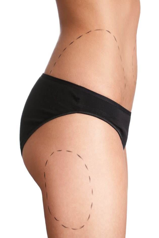 Body correction with the help of plastic surgery, side view
