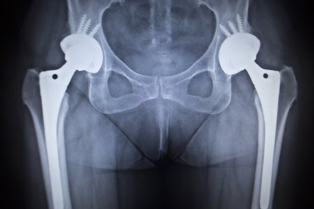 X-ray scan image of hip joint replacement orthopedic implant