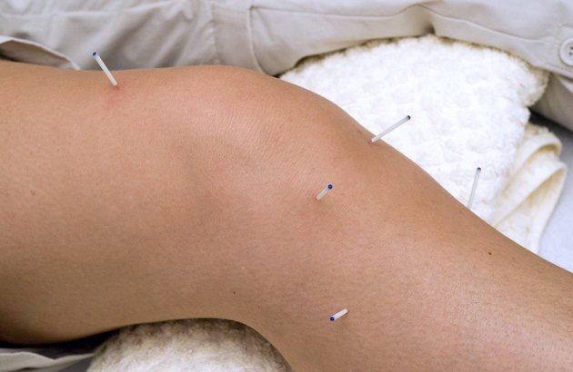 Acupuncture