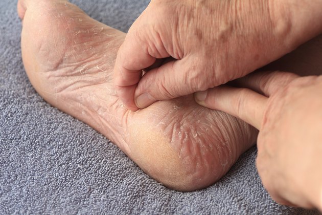 Man peeling dry skin from his foot