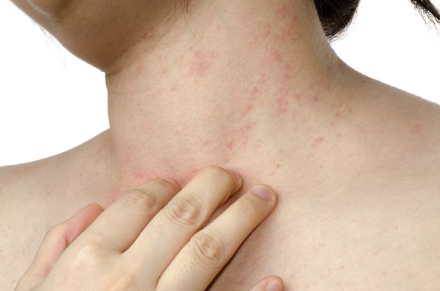 causes-of-itchy-red-bumps-on-the-neck-livestrong