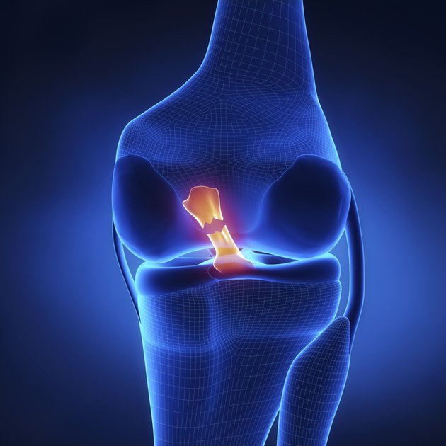 Torn Anterior Cruciate Ligament