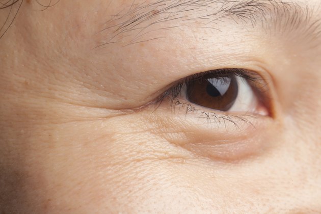Eye wrinkles