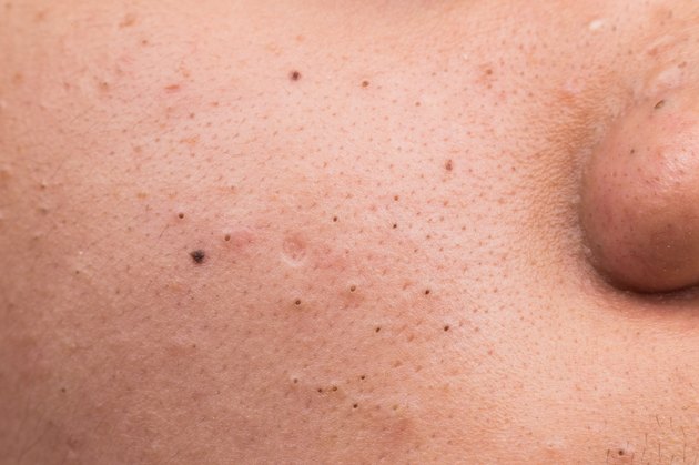 Closed up of pimple blackheads on face