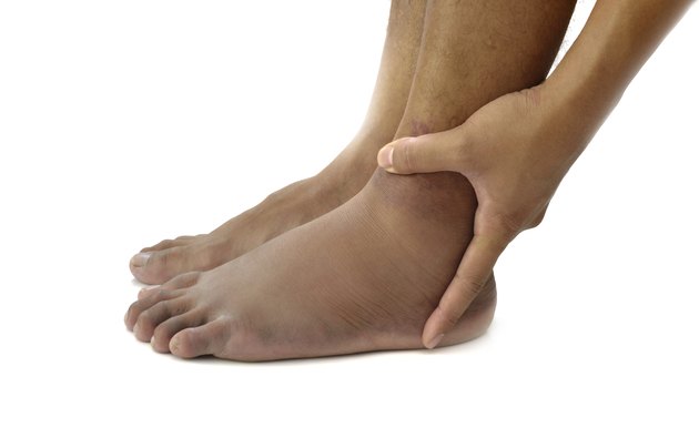 ankle sprain