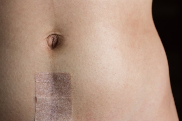 Stomach with Recovering Cesarean Section Scar