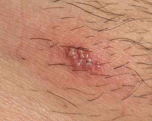 Herpes on the human body