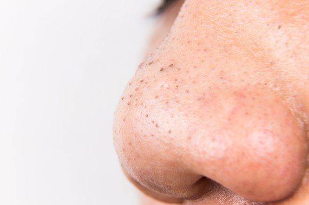 Ugly pimples, acne, zit, blackheads on the nose of teenager