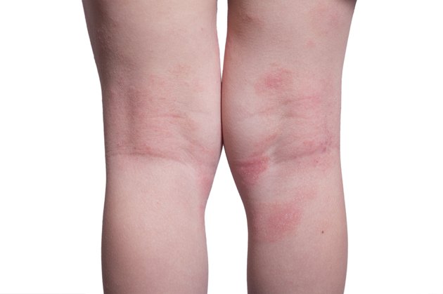 Eczema on the kid's legs
