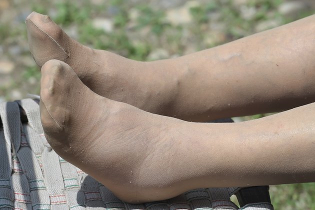 swollen feet close up