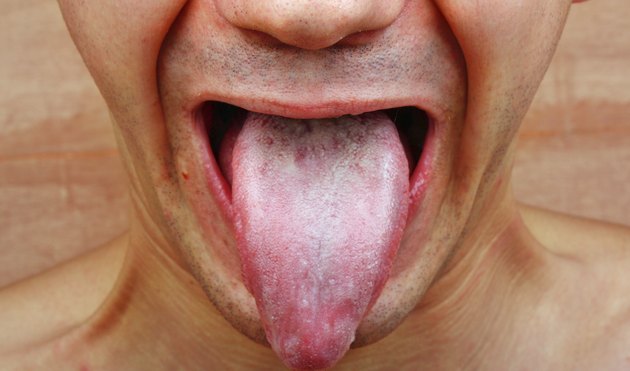 What Are The Causes Of Tongue Fungus 5590