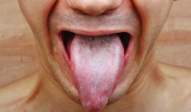 What Are The Causes Of Tongue Fungus Livestrong