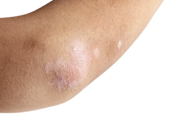 home-remedies-for-dry-itchy-skin-on-elbows-livestrong