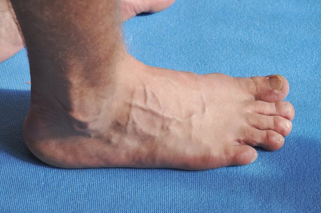 Toenail fungus with varicose veins