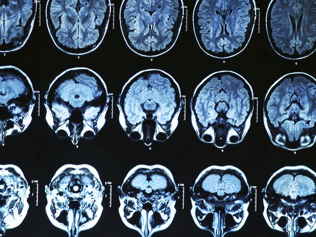 MRI Brain Scan