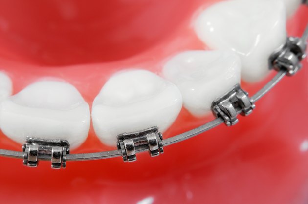 What To Do If Kids Need Braces And You Cant Afford Them