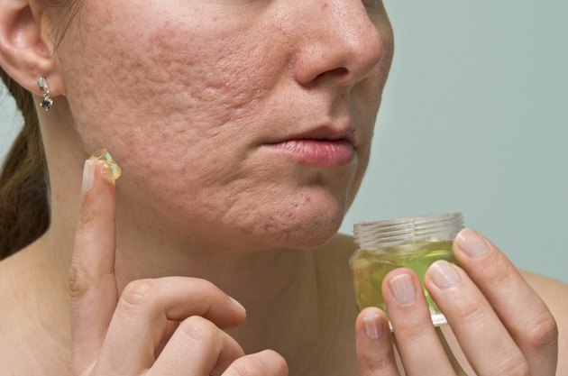 Acne therapy