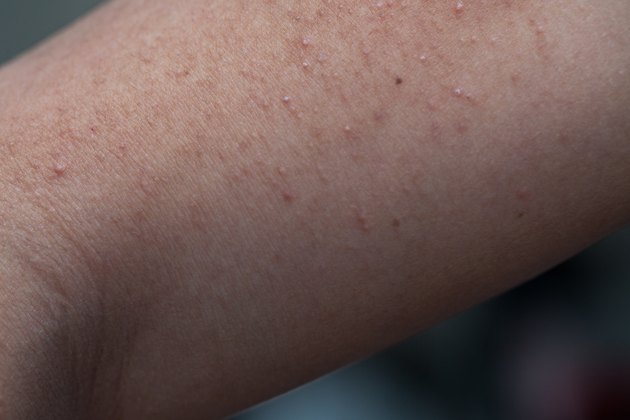 How to Get Rid of White Pimples | Livestrong.com