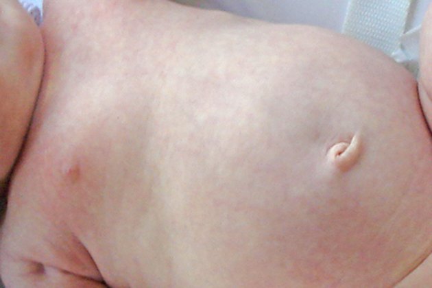 How Long Does It Take for a Baby's Belly Button to Heal ...