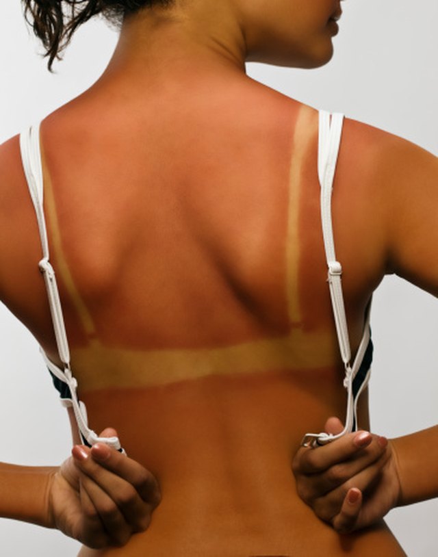 itchy-skin-from-sun-exposure-livestrong