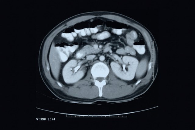 symptoms-of-a-partial-bowel-blockage-livestrong