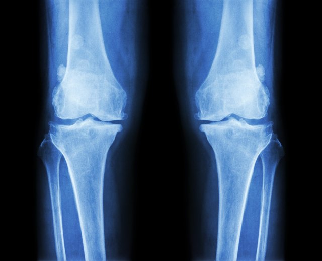 Top Bone Diseases | Livestrong.com