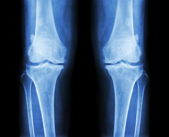 top-bone-diseases-livestrong