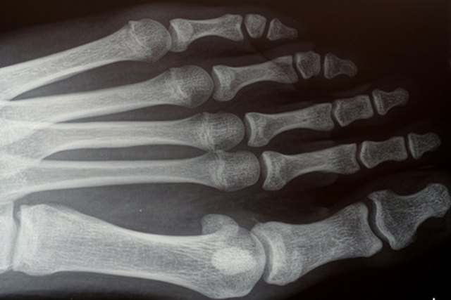 Diseases Of Excessive Bone Growth | Livestrong.com