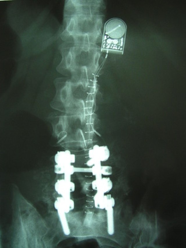 Bruised or Broken Tailbone Symptoms | Livestrong.com