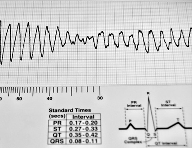 flutter in chest during exercise