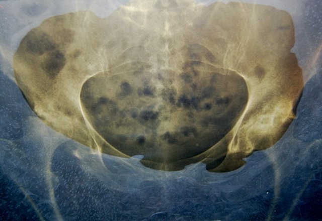 What Does Cancer In The Hip Bone Feel Like