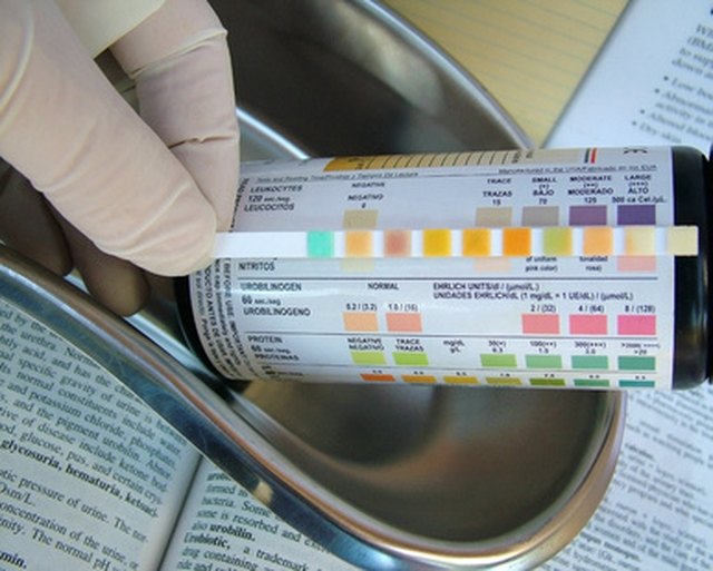 What Is Normal Amount Of Protein In Urine 9859