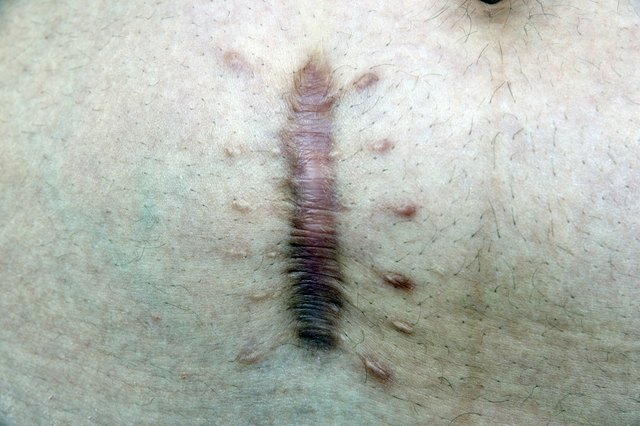 skin scar